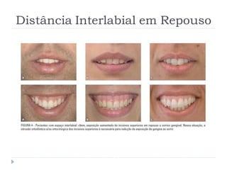Distância Interlabial em Repouso
 