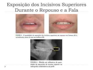 Exposição dos Incisivos Superiores
Durante o Repouso e a Fala
 