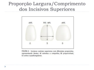 Proporção Largura/Comprimento
dos Incisivos Superiores
 