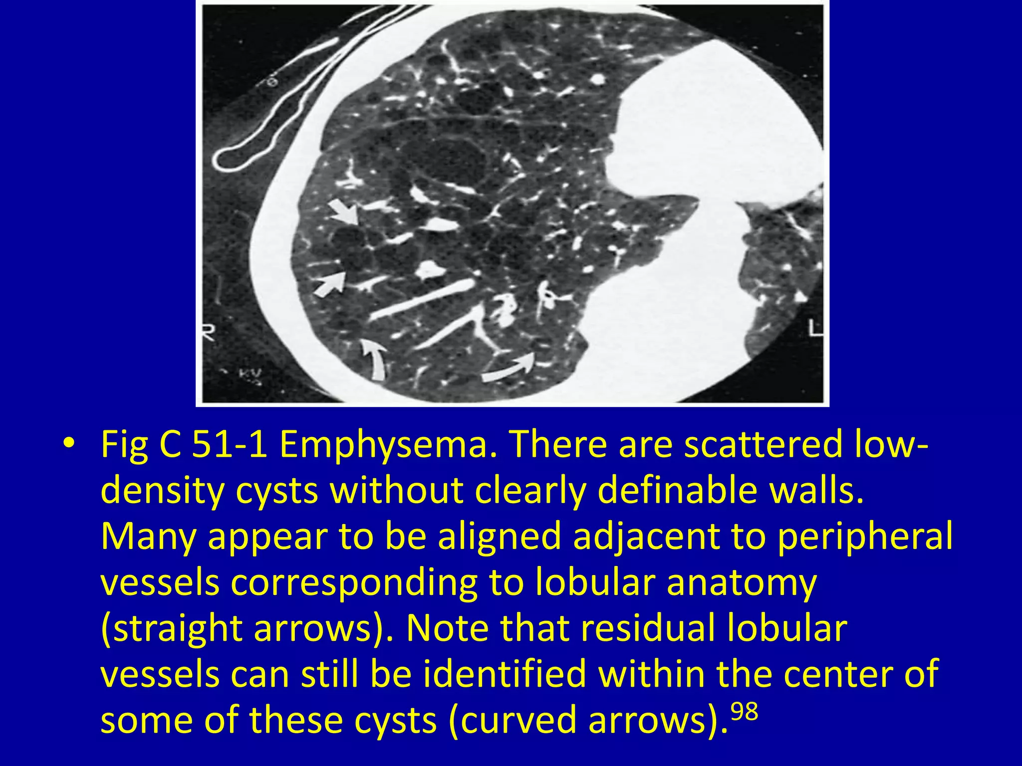 51 cystic lung disease on computed tomography | PPTX