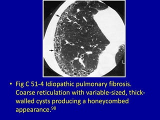 51 cystic lung disease on computed tomography | PPTX