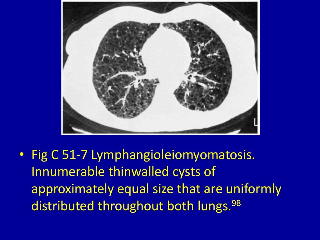 51 cystic lung disease on computed tomography