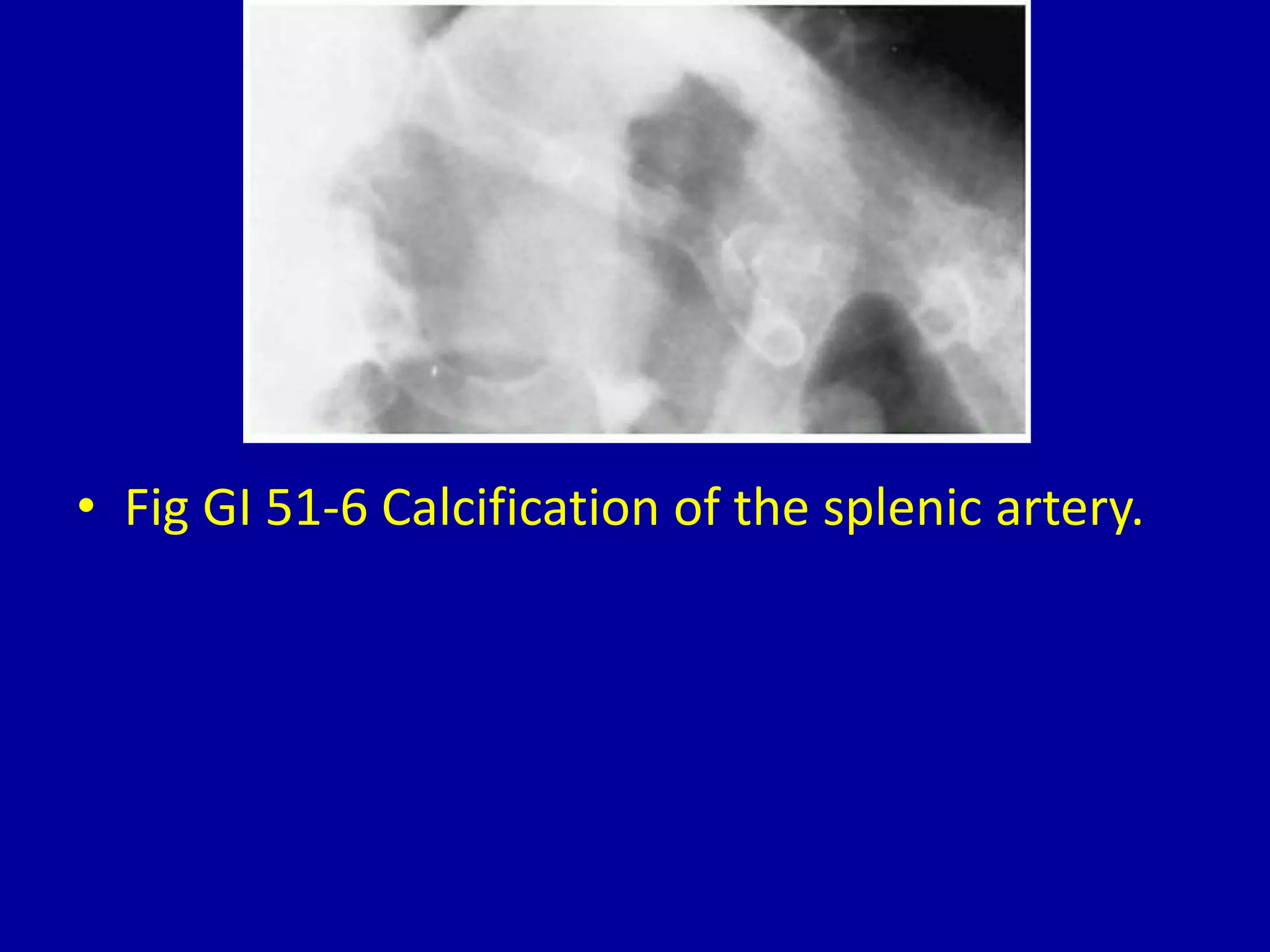 • Fig GI 51-6 Calcification of the splenic artery.
 