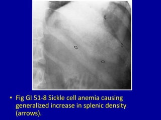 • Fig GI 51-8 Sickle cell anemia causing
generalized increase in splenic density
(arrows).
 