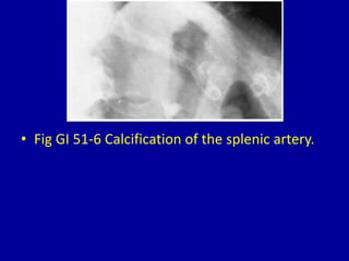 • Fig GI 51-6 Calcification of the splenic artery.
 