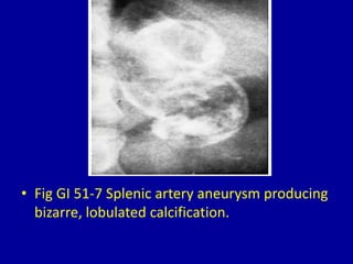 • Fig GI 51-7 Splenic artery aneurysm producing
bizarre, lobulated calcification.
 