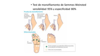 • Test de monofilamento de Semmes-Weinsted
sensibilidad 95% y especificidad 80%
 