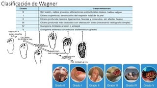 Clasificación de Wagner
 