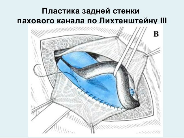 По опелю поликарпову