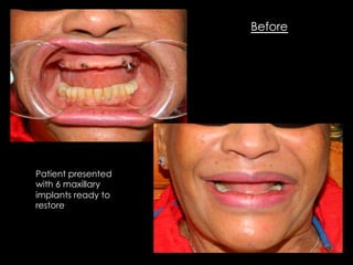 Before
Patient presented
with 6 maxillary
implants ready to
restore
 