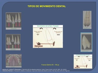 TIPOS DE MOVIMIENTO DENTAL
Fuerza Óptima 50 - 100 gr.
Isaacson R, Lindaver S, Rubenstein L: Moments with the edgewise appliance. Incisor Torque Control. AJO-DO 1993: 103: 428-38.
Ventureira Pedrosa C. Prescripción variable en ortodoncia: lo que todo ortodoncista debería conocer. Rev Esp Ortod. 2010; 40: Pag 9-24.
 