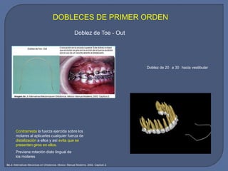 DOBLECES DE PRIMER ORDEN
Doblez de Toe - Out
Contrarresta la fuerza ejercida sobre los
molares al aplicarles cualquier fuerza de
distalización a ellos y así evita que se
presenten giros en ellos.
Previene rotación disto lingual de
los molares
Doblez de 20 a 30 hacia vestibular
Ito J: Alternativas Mecánicas en Ortodoncia. México: Manual Moderno, 2002. Capítulo 2.
 