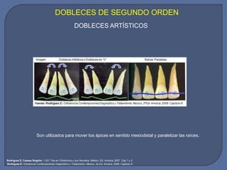 Son utilizados para mover los ápices en sentido mesiodistal y paralelizar las raíces.
DOBLECES ARTÍSTICOS
DOBLECES DE SEGUNDO ORDEN
Rodríguez E, Casasa Rogelio: 1.001 Tips en Ortodoncia y sus Secretos. México. Ed. Amolca; 2007. Cap 1 y 2.
Rodríguez E: Ortodoncia Contemporánea Diagnóstico y Tratamiento. México, 2a Ed. Amolca, 2008. Capítulo 8.
 