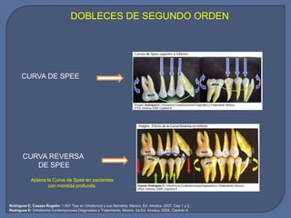 DOBLECES DE SEGUNDO ORDEN
CURVA DE SPEE
CURVA REVERSA
DE SPEE
Aplana la Curva de Spee en pacientes
con mordida profunda.
Rodríguez E, Casasa Rogelio: 1.001 Tips en Ortodoncia y sus Secretos. México. Ed. Amolca; 2007. Cap 1 y 2.
Rodríguez E: Ortodoncia Contemporánea Diagnóstico y Tratamiento. México, 2a Ed. Amolca, 2008. Capítulo 8.
 