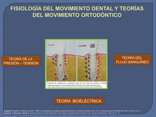 TEORÍA DE LA
PRESIÓN – TENSIÓN
TEORÍA BIOELÉCTRICA
TEORÍA DEL
FLUJO SANGUÍNEO
Droghetti P, Cruzat F: Participación de Mt1 – MMP en la remodelación del ligamento periodontal durante la movilización dentaria. Rev. Clin. Periodoncia Implantol. Rehabilit Oral. 2010 Vol. 3(3); 113-117
Kameyama T, Matsumoto, Warita H: Inactived periods of constant orthodontic forces related to desirable tooth movement in rats. Journal of Orthodontics. 2003; 30: 31 - 37
 