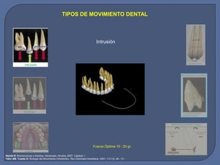 TIPOS DE MOVIMIENTO DENTAL
Fuerza Óptima 10 - 20 gr.
Nanda R: Biomecánicas y Estética. Venezuela: Amolca, 2007. Capítulo 1.
Tafur AM, Tuesta O: Biología del Movimiento Ortodóntico. Rev Estomatol Herediana. 2001; 11(1-2): 46 – 51.
Intrusión
 