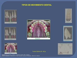TIPOS DE MOVIMIENTO DENTAL
Fuerza Óptima 35 - 60 gr.
Nanda R: Biomecánicas y Estética. Venezuela: Amolca, 2007. Capítulo 1.
Smith R. Burstone J: Mechanics of Tooth movement. Journal of Orthodontic. 1984. 85-4. 294-307.
 