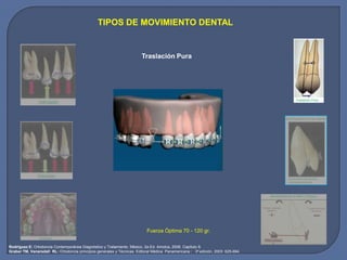 TIPOS DE MOVIMIENTO DENTAL
Rodríguez E: Ortodoncia Contemporánea Diagnóstico y Tratamiento. México, 2a Ed. Amolca, 2008. Capítulo 8.
Graber TM, Vanarsdall RL: Ortodoncia principios generales y Técnicas. Editoral Médica Panamericana ; 3a edición, 2003: 625-694.
Traslación Pura
Fuerza Óptima 70 - 120 gr.
 