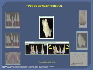 TIPOS DE MOVIMIENTO DENTAL
Rodríguez E: Ortodoncia Contemporánea Diagnóstico y Tratamiento. México, 2a Ed. Amolca, 2008. Capítulo 8.
Smith R. Burstone J: Mechanics of Tooth movement. Journal of Orthodontic. 1984. 85-4. 294-307.
Fuerza Óptima 35 - 60 gr.
 