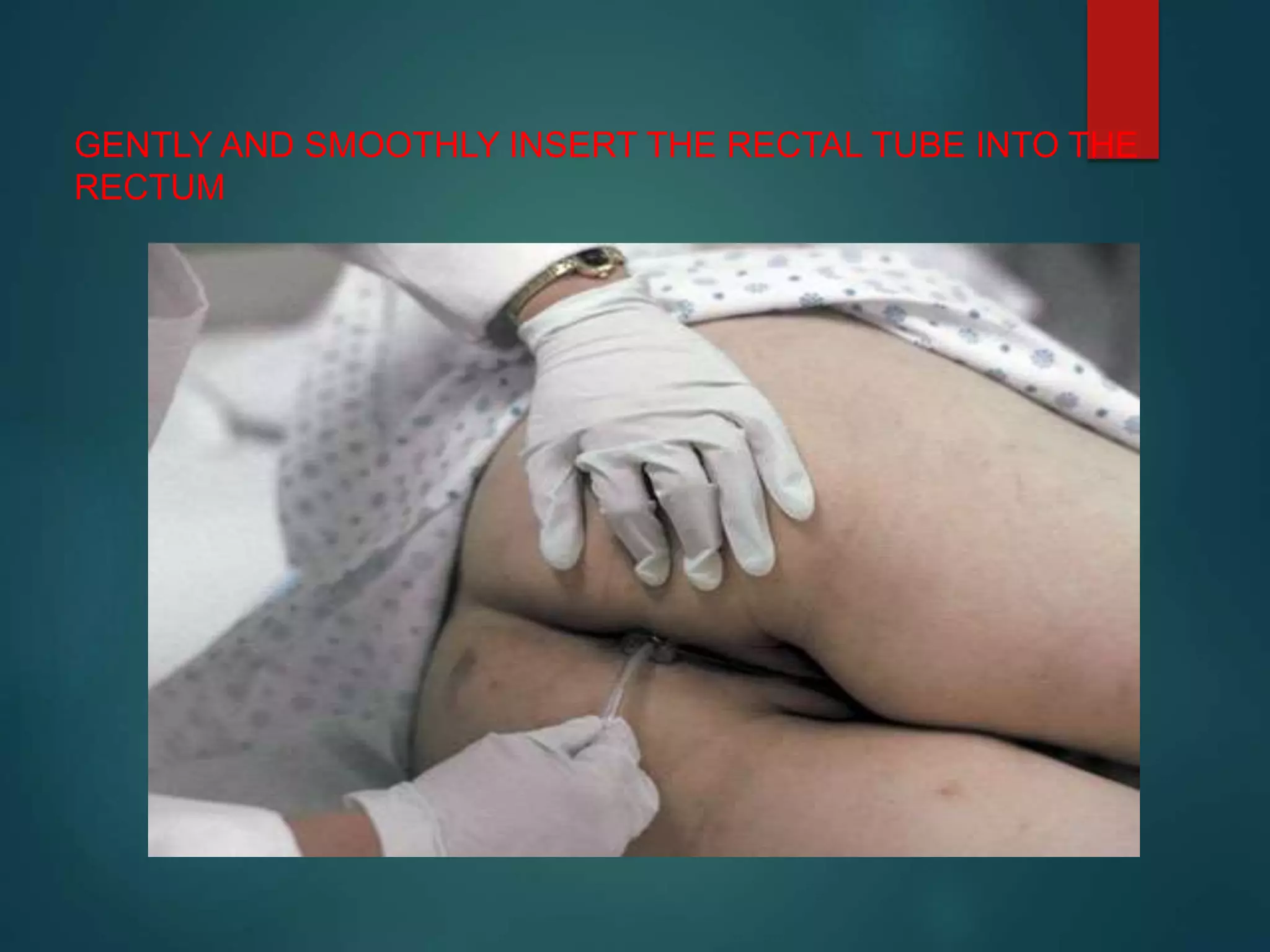 GENTLY AND SMOOTHLY INSERT THE RECTAL TUBE INTO THE
RECTUM
 