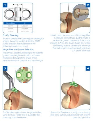 1
3 4
X 2
Pre-Op Planning:
A careful preoperative planning and radiological
analysis should be used to define the CORA,
plane, direction and magnitude of the
deformity intended to correct.
Hinge Plate and Screws Selection:
The device is selected according to the patient’s
growth plate height and location to prevent
invasion or damage of the physis. These
variables define the plate size and screw length.
Initial location for placement of the Hinge Plate
is achieved by inserting a guiding K-wire to
localize the growth plate under fluoroscopic
imaging (C-Arm). The K-wire should be inserted
considering that the centerline of the Hinge
Plate will be placed approximately at 6.5mm
(1/4’’) from the K-wire
The Template is placed over the growth plate
using the Croc Holder that is guided by the
previously positioned K-wire.
Release the Template and verify proper seating
over bone surface and alignment with growth
plate through C-Arm
Hinge Plate X
12 mm 5.95 mm
16 mm 9.95 mm
20 mm 13.95 mm
K-wire
6.5 mm (¼“)
 