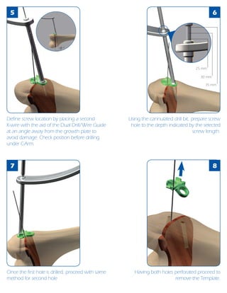 5
8
6
7
θ°
Define screw location by placing a second
K-wire with the aid of the Dual Drill/Wire Guide
at an angle away from the growth plate to
avoid damage. Check position before drilling
under C-Arm.
Once the first hole is drilled, proceed with same
method for second hole
Using the cannulated drill bit, prepare screw
hole to the depth indicated by the selected
screw length.
Having both holes perforated proceed to
remove the Template.
30 mm
25 mm
35 mm
 