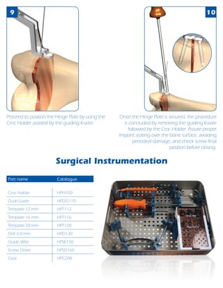 9 10
Once the Hinge Plate is secured, the procedure
is concluded by removing the guiding K-wire
followed by the Croc Holder. Assure proper
implant seating over the bone surface, avoiding
periosteal damage, and check screw final
position before closing.
Proceed to position the Hinge Plate by using the
Croc Holder assisted by the guiding K-wire.
Part name Catalogue
Croc Holder HPH100
Dual Guide HPDG110
Template 12 mm HPT112
Template 16 mm HPT116
Template 20 mm HPT120
Drill 3.0 mm HPD130
Guide Wire HPW150
Screw Driver HPSD160
Case HPC200
Surgical Instrumentation
 