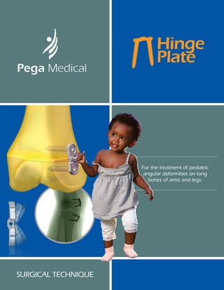 For the treatment of pediatric
angular deformities on long
bones of arms and legs.
Surgical technique
 