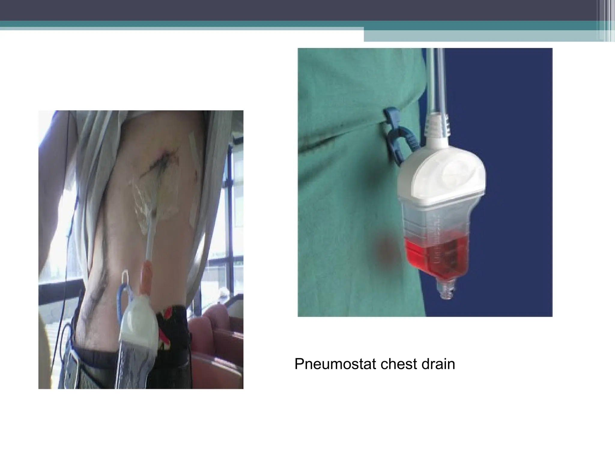 Pneumostat chest drain
 
