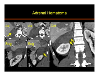 Adrenal Hematoma
Sag
Ax
Sag
Ax Cor
 