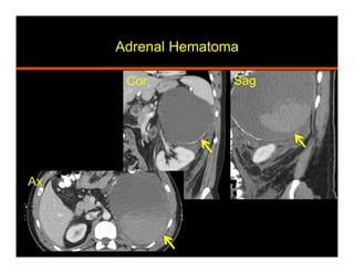 Adrenal Hematoma
Cor Sag
Ax
 