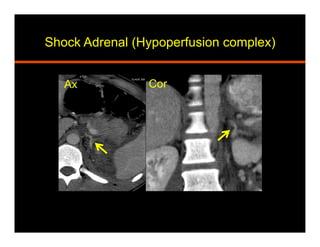 Shock Adrenal (Hypoperfusion complex)
Ax Cor
 