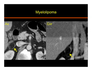 Myelolipoma
Ax Cor
 