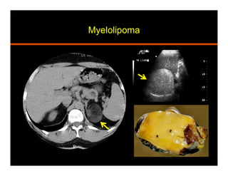 Myelolipoma
 