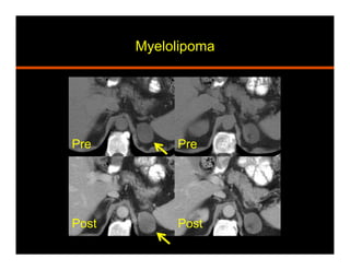 Myelolipoma
Pre Pre
PostPost
 