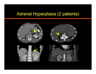 Adrenal Hyperplasia (2 patients)
 