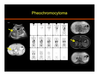 Pheochromocytoma
 
