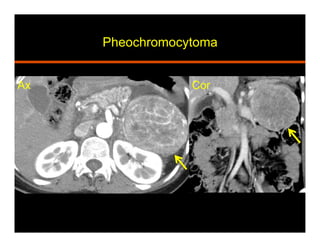 Pheochromocytoma
Ax Cor
 
