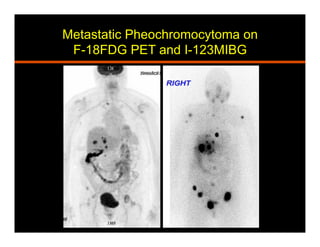 Metastatic Pheochromocytoma on
F-18FDG PET and I-123MIBG
 