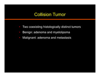 Collision Tumor
•  Two coexisting histologically distinct tumors
•  Benign: adenoma and myelolipoma
•  Malignant: adenoma and metastasis
 