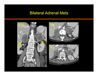 Bilateral Adrenal Mets
Cor Ax
Ax
 