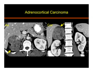 Adrenocortical Carcinoma
Ax Cor
 