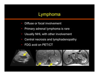 Lymphoma
•  Diffuse or focal involvement
•  Primary adrenal lymphoma is rare
•  Usually NHL with other involvement
•  Central necrosis and lymphadenopathy
•  FDG avid on PET/CT
 