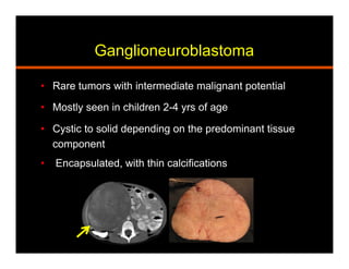 Ganglioneuroblastoma
•  Rare tumors with intermediate malignant potential
•  Mostly seen in children 2-4 yrs of age
•  Cystic to solid depending on the predominant tissue
component
•  Encapsulated, with thin calcifications
 