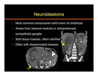 Neuroblastoma
•  Most common extracranial solid tumor of childhood
•  Arises from adrenal medulla or retroperitoneal
sympathetic ganglia
•  Soft tissue masses, often calcified
•  Often with disseminated disease
 