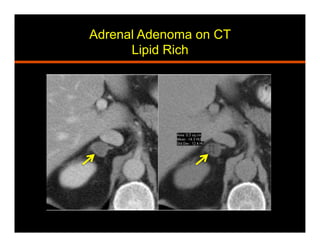 Adrenal Adenoma on CT
Lipid Rich
 