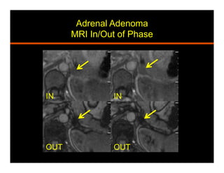 Adrenal Adenoma
MRI In/Out of Phase
ININ
OUT OUT
 