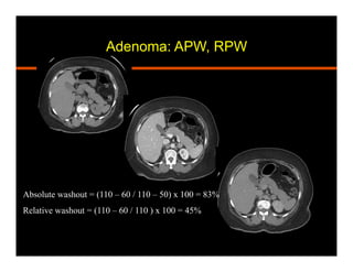 Absolute washout = (110 – 60 / 110 – 50) x 100 = 83%
Relative washout = (110 – 60 / 110 ) x 100 = 45%
Adenoma: APW, RPW
 