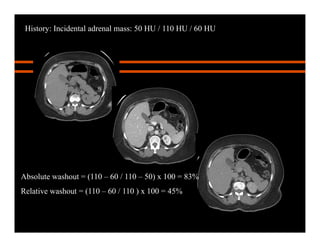 History: Incidental adrenal mass: 50 HU / 110 HU / 60 HU
Absolute washout = (110 – 60 / 110 – 50) x 100 = 83%
Relative washout = (110 – 60 / 110 ) x 100 = 45%
 