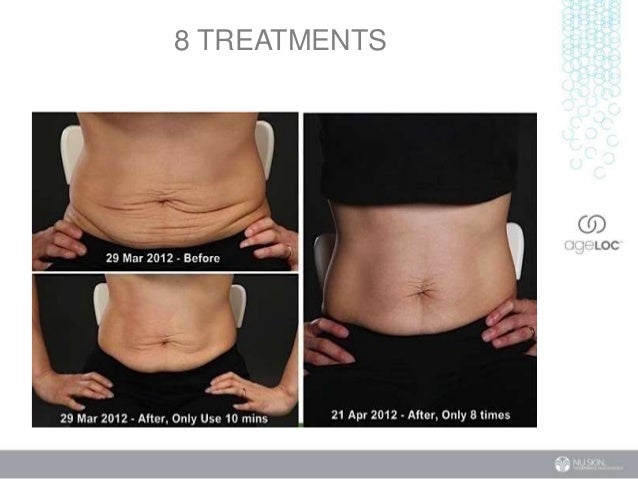 Before &amp; After Pictures MicroCurrent Face Lift Results